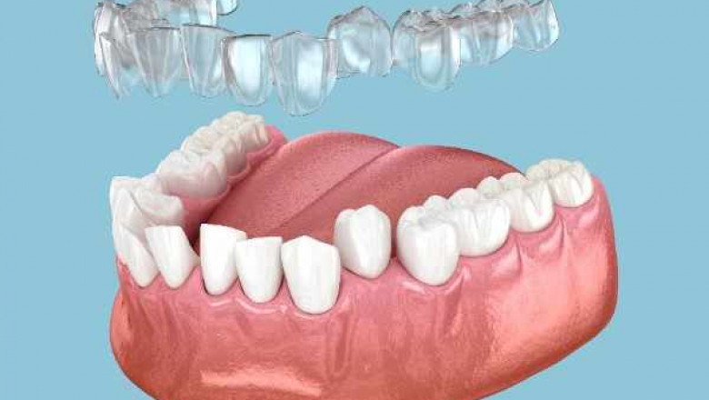 Invisible Smile Restorations in Newcastle