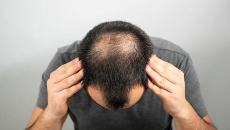 Hair Transplant Etiquette in Dubai