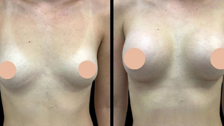 How Breast Augmentation in Dubai Compares to Other Cosmetic Procedures for Enhancing Your Figure