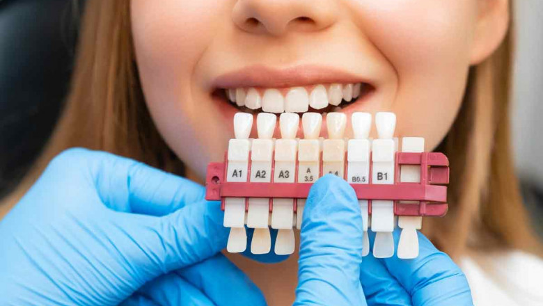 How Do Dental Veneers Reshape Your Smile?