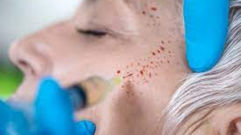 How Often Should You Get a Vampire Facial for Best Results?