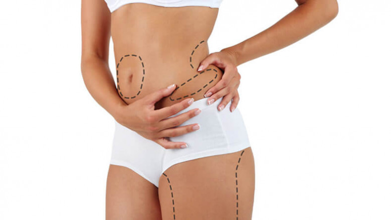 How to Prepare for Your Liposuction Surgery