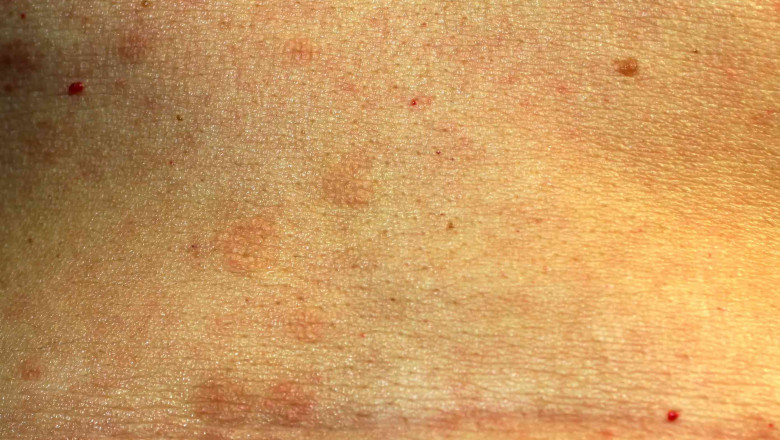 The Evolving Treatment Paradigm: Current Therapies and Emerging Innovations in the Lichen Planus Market