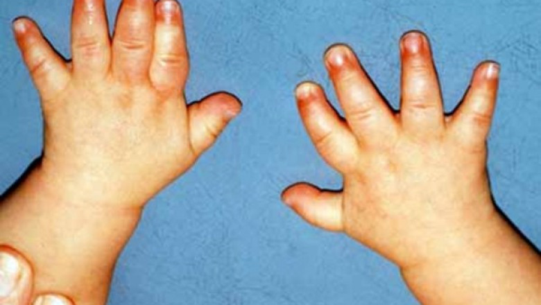 Geographical Report on the Prader-Willi Syndrome (PWS) Market