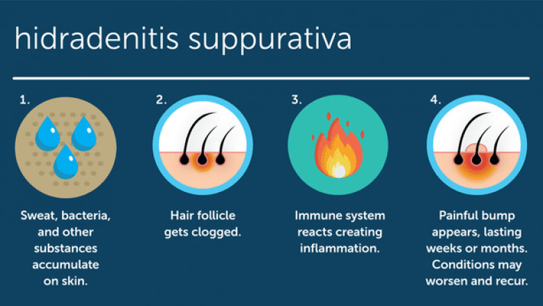 Hidradenitis Suppurativa: Causes, Symptoms, and Treatment - Philadelphia Holistic Clinic