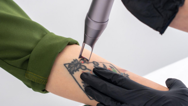 How Picosure Tattoo Removal Targets Deep Ink with Precision