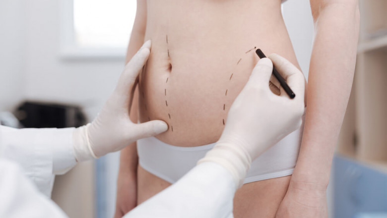 Liposuction Guide for Beginners: Everything You Need to Know