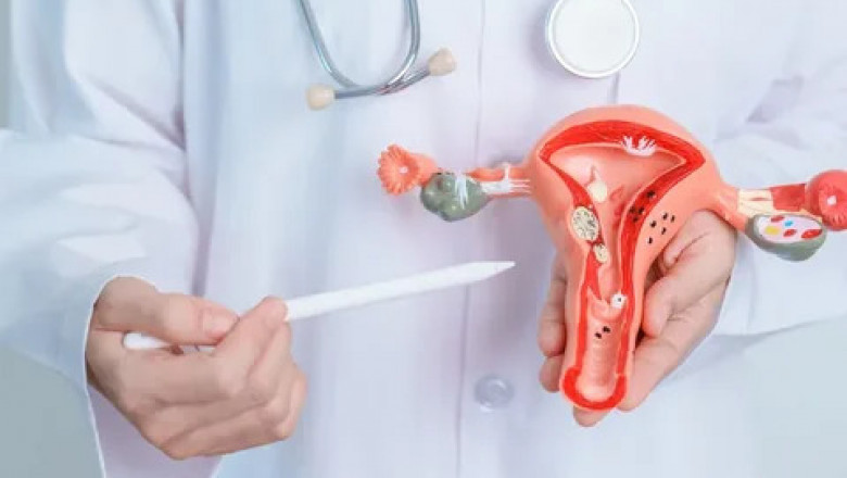 Polycystic Ovary Syndrome (PCOS) Treatment Market Growth Owing to Rising Awareness