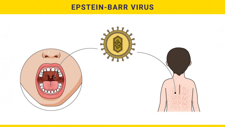 The Clinical Impact of Epstein-Barr Virus (EBV) market Diagnosis, Management, and Long-Term Consequences