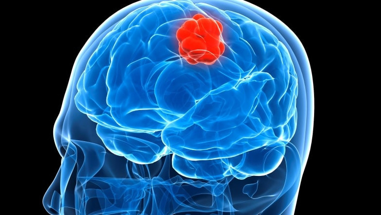 The Geographical Landscape of the Glioblastoma Market: Regional Insights and Trends