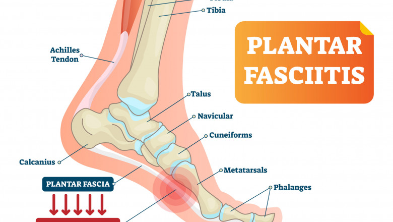 Treatment for plantar fasciitis - Philadelphia Holistic Clinic