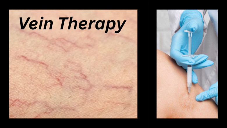Vein therapy