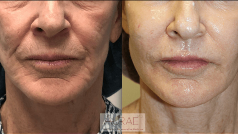 Achieve Radiant and Youthful Skin with Wellness Medical Clinic Expert Treatments