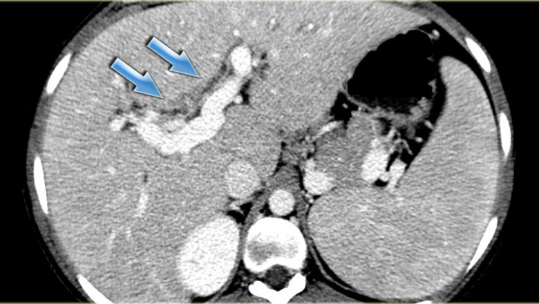 Biliary Tumor Market to Grow with Targeted Therapy Advances