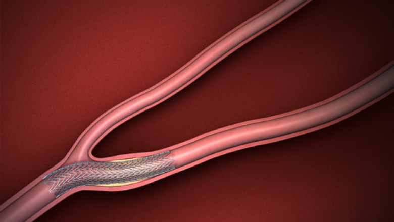 Carotid Artery Stent Market is Anticipated to Witness High Growth Owing to Rising Incidence of Carotid Stenosis