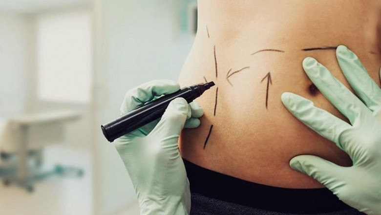 How Liposuction Works to Remove Stubborn Fat