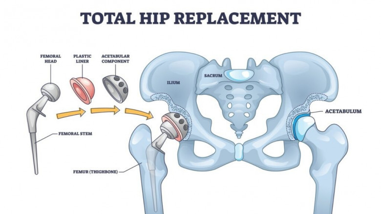 Understanding Total Hip Replacement Surgery in Delhi: A Modern Approach to Restoring Mobility