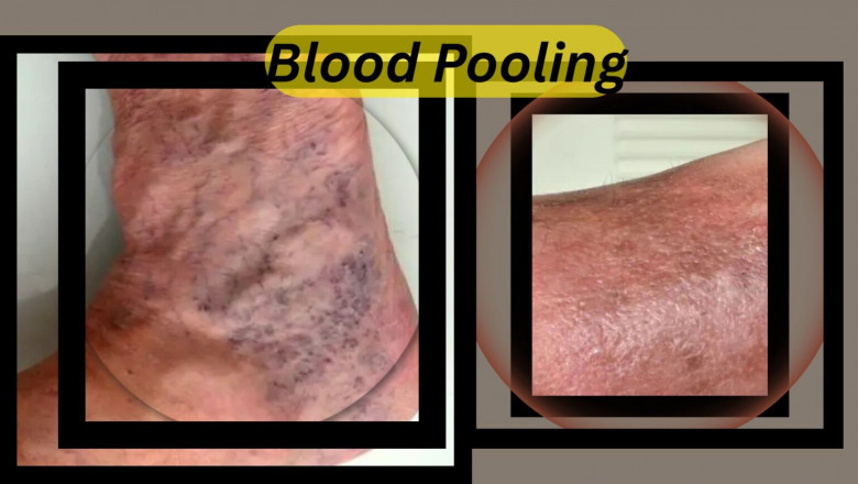 Is Blood Pooling Dangerous