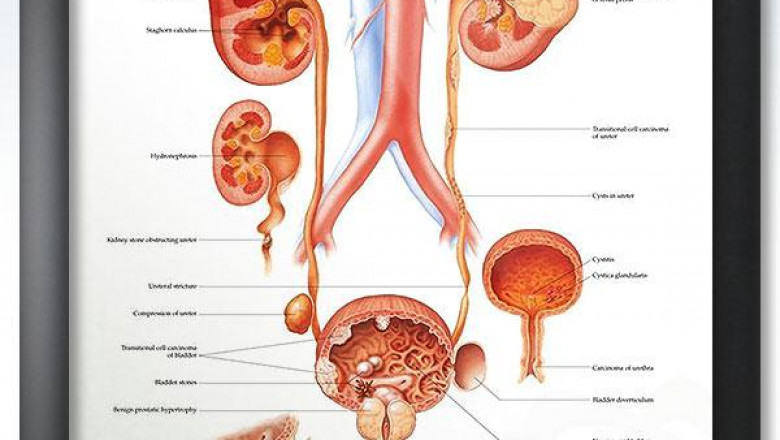 Natural Remedies for Urinary Tract Diseases | Dr. Tsan and Team