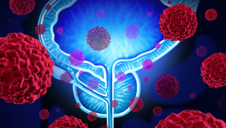Neuroendocrine Prostate Cancer Market to Grow Rapidly Owing to Novel Therapeutics
