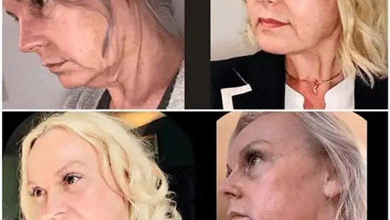 Refine Texture with Profhilo Treatment in Dubai