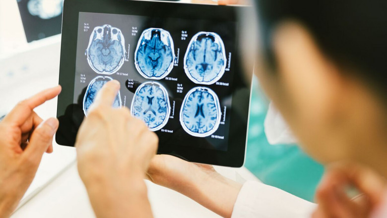 Chronic Traumatic Encephalopathy Market to Grow Owing to Diagnostic Innovations