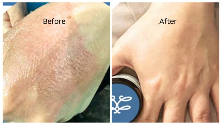 Gentle, Effective Body Creams for Eczema Relief