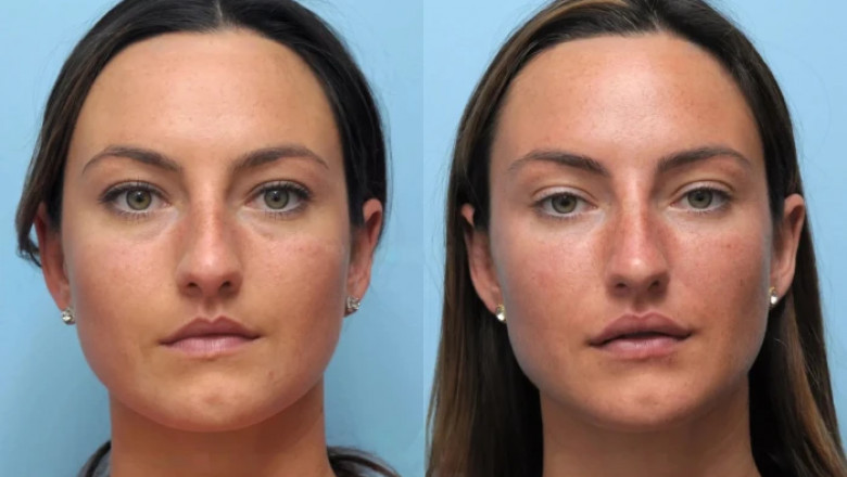 Real Results from Thread Lift Treatments in Dubai