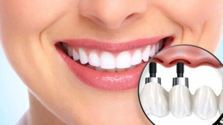 Upgrade Your Smile with Dental Implants