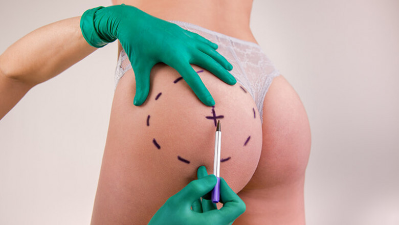 What Is Recovery Like After Buttock Augmentation?