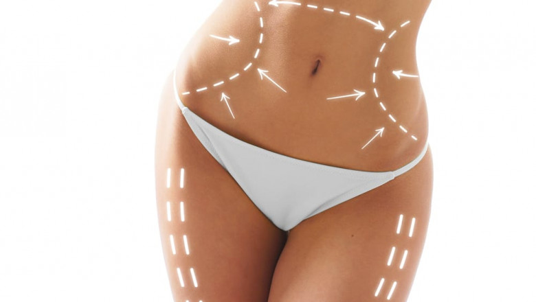 It’s Time to Reshape – Try Laser Liposuction in Dubai