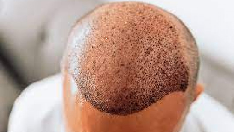 What Are the Risks of Hair Transplants?
