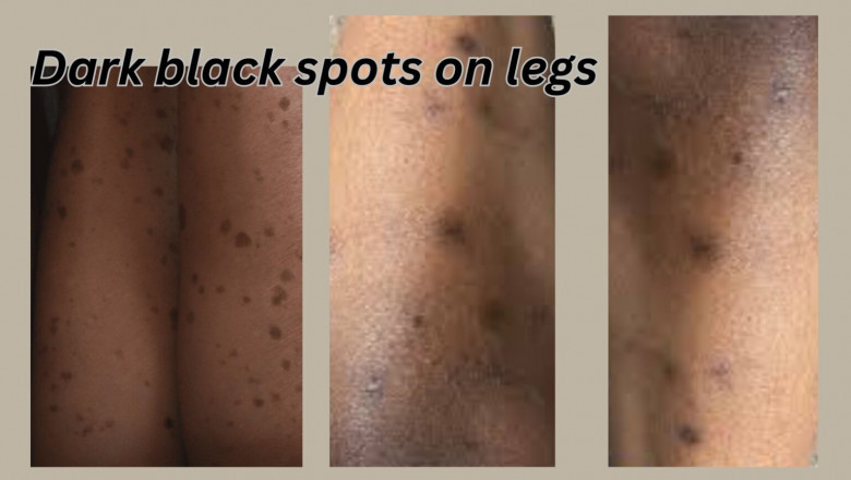 Dark Black Spots On Legs