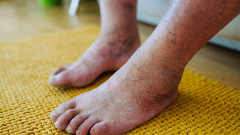 Diabetic Peripheral Neuropathy Market to Rise Owing to Diabetes Prevalence