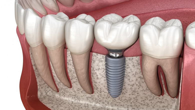 A New You Begins with Dental Implants