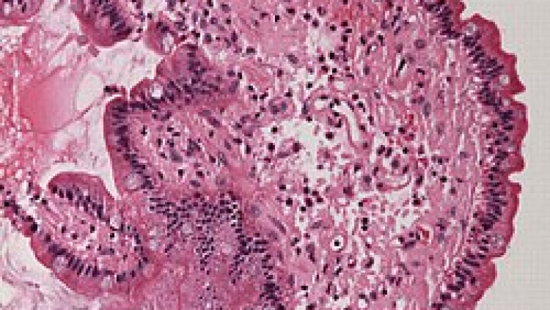 AL Amyloidosis Diagnostic Market to Soar on Advanced Biomarker Profiling