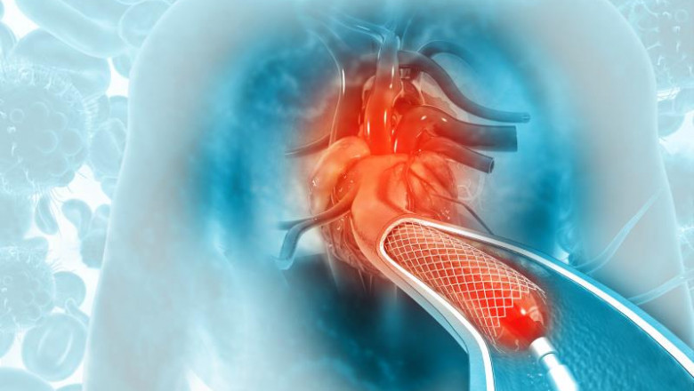 Angioplasty Balloons Market Analysis: Regional Growth Patterns and Market Share Distribution Across Key Geographies