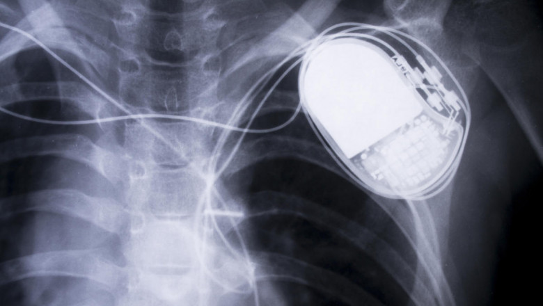 Cardiac Pacemaker Market Benefits from Higher Awareness and Investments in Heart Rhythm Treatments