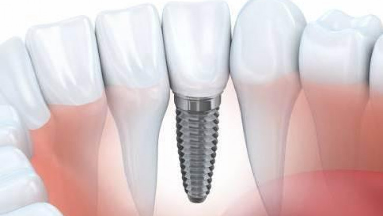 Dental Bone Graft Substitute Market: Reshaping the Future of Oral Regeneration