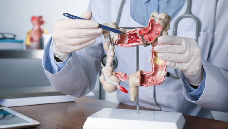 Gastrointestinal Cancer Surgery in Delhi: Expert Care for Complex Conditions