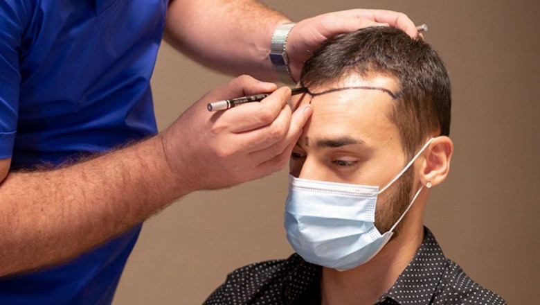 How to Maximize Results After a Hair Transplant in Islamabad