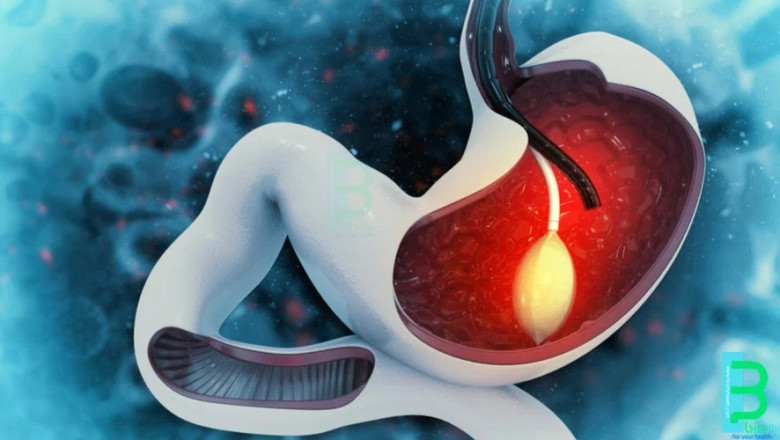 Intragastric Balloon Market is Anticipated to Witness High Growth Owing to Rising Obesity Rates