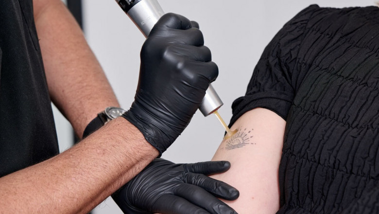 Picosure Tattoo Removal for Sensitive Skin: Safe and Highly Effective