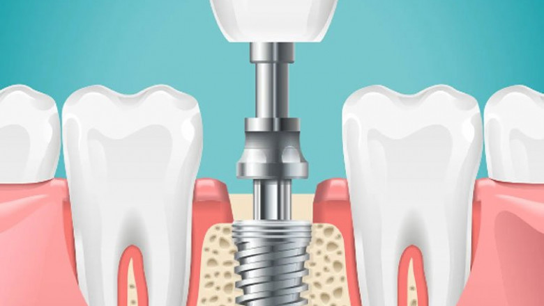 Regain Confidence with a Single Tooth Implant in Dubai