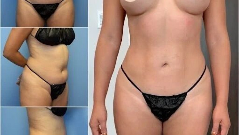 The Cost of Body Contouring Surgery in dubai: A Comprehensive Breakdown