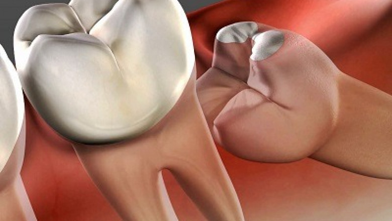 Dental Fees: Tooth Extraction Dubai