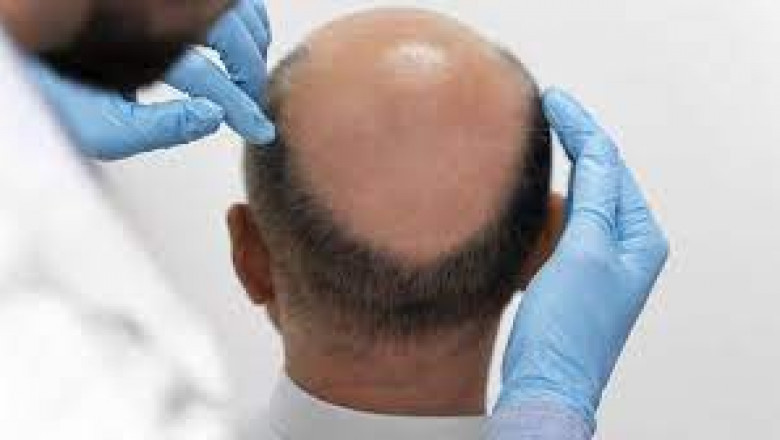 How Many Grafts Do You Need for a Hair Transplant?