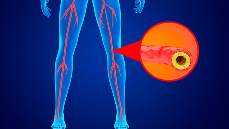 Peripheral Arterial Disease Market to Surge Owing to Innovative Therapies