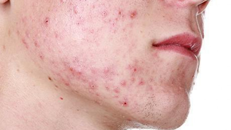 Top Tech for Clear Skin: Acne Treatment in Dubai
