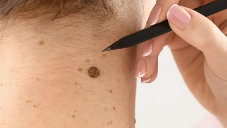 Get Rid of Warts and Skin Tags Safely with Advanced Treatment in Delhi